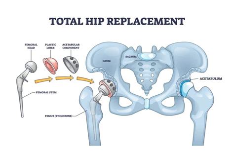 Hip Replacement Work Restrictions