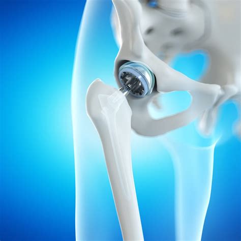 hip surgery vs hip replacement