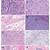 histologic types of breast cancer