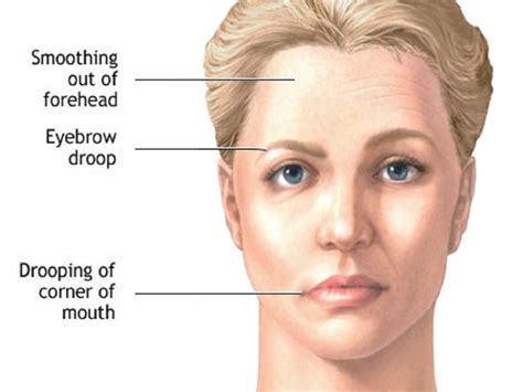 history of bell's palsy icd 10