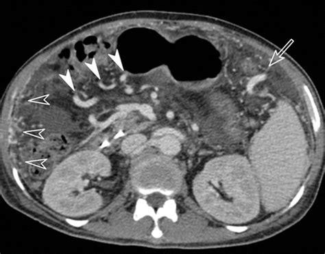 history of esophageal varices icd 10