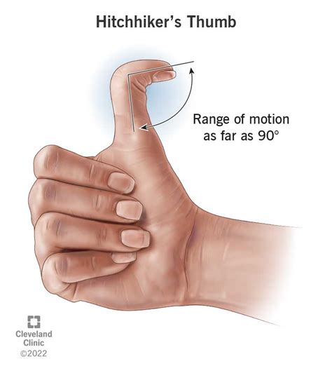 Hitchhiker Thumb Vs Normal