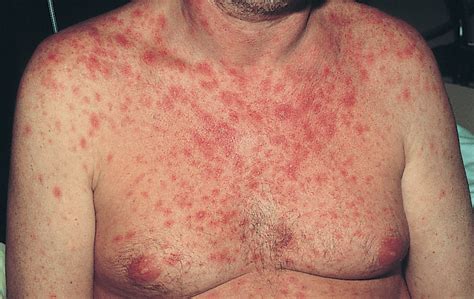 HIV Rash What Does It Look Like and How Is It Treated?