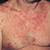 hiv early symptom rash
