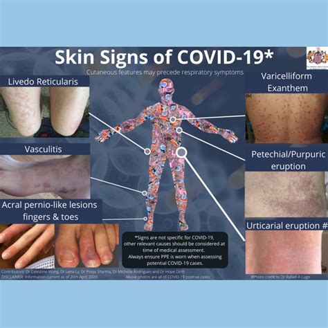 Covid Rash In Kids Coronavirus Symptoms Skin Rash Could