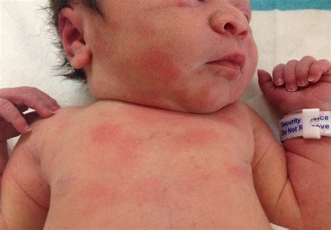 hives newborn face