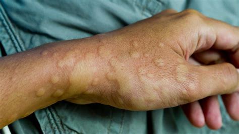 Understanding and Managing Hives on Hands: Causes, Symptoms, and Effective Treatments