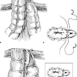Colon Health Alert: What Causes a Hole in Colon?