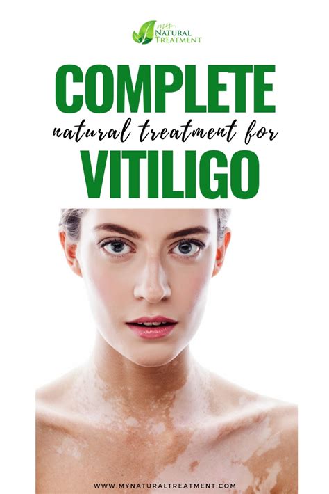 holistic treatment for vitiligo