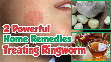 Natural Home Remedies for Ringworm. Ringworm is a known fungal