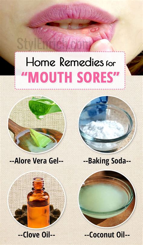 15 Canker Sore Relief Remedies That Work Canker sore on gum, Sore in