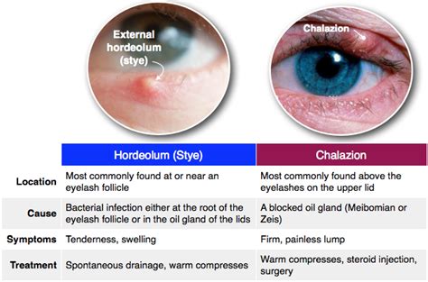 hordeolum externum