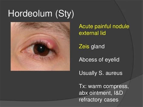 hordeolum externum right upper eyelid icd 10