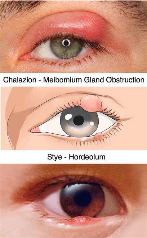 hordeolum vs blepharitis