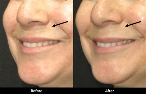 Understanding The Horizontal Crease Above The Upper Lip After Filler In 2023