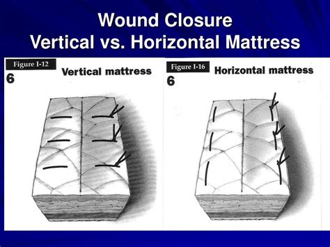 horizontal versus vertical mattress suture