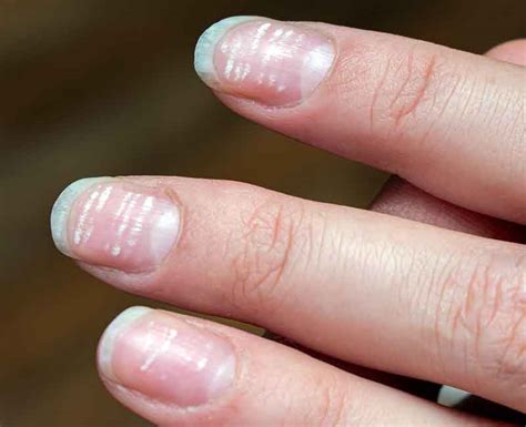 Horizontal White Lines On Nails Causes