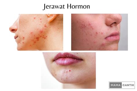 hormon dan jerawat
