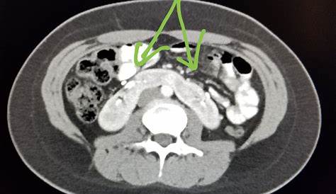 Horseshoe kidney CT wikidoc