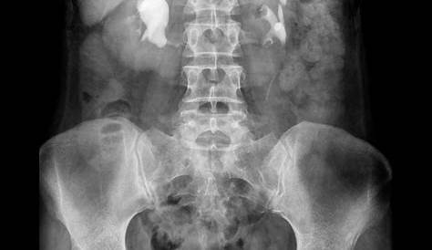 Horseshoe Kidney Ivp On Intravenous Pyelogram Image