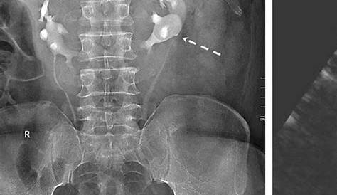 Horseshoe kidney on intravenous pyelogram Image
