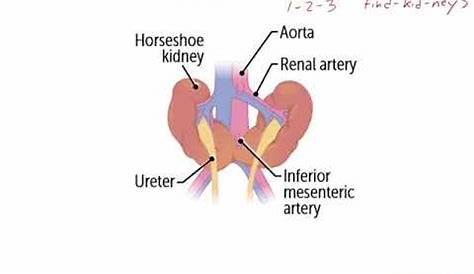 What is Horseshoes Kidney ? Horseshoe kidney Treatment