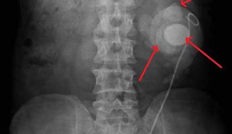 Horseshoe Kidney Xray Intravenous Pyelogram (IVP) In A Male Patient