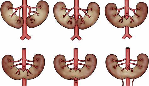 Horseshoe Kidney Photograph By Medimage/science Photo Library