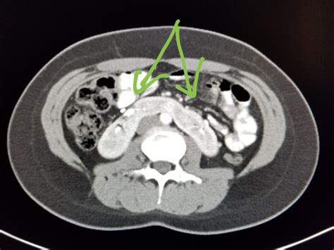 horseshoe kidney ct images
