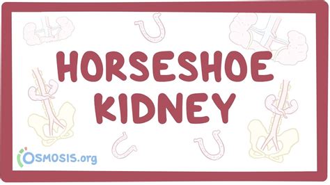 horseshoe kidney medical term