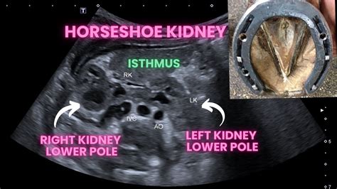 horseshoe kidney newborn