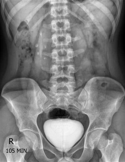 horseshoe kidney radiopaedia