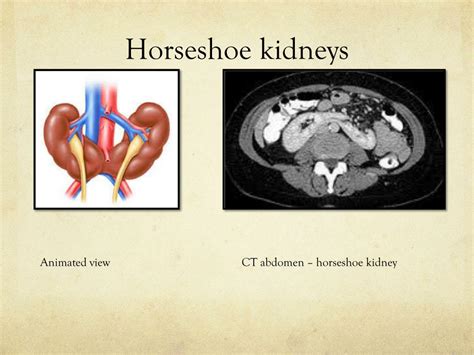 horseshoe kidney risks