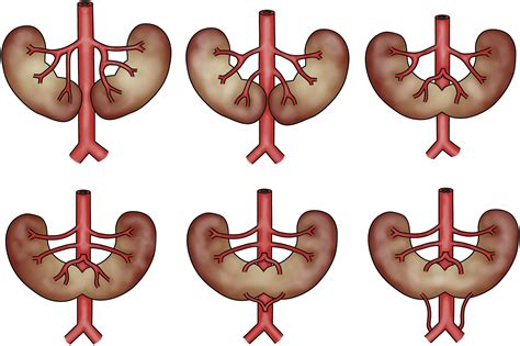 horseshoe shaped kidney