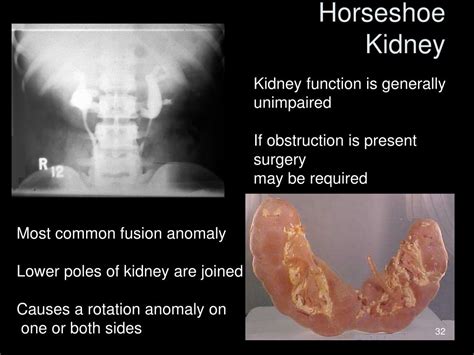 Horseshoe Vs Kidney Table