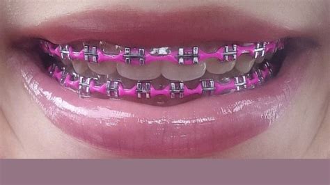 Trendy Hot Pink Braces: Fashionable Orthodontics That Turn Heads