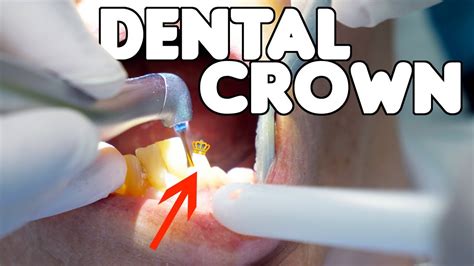 Five Things You Should Ask Your Dentist Before Getting A Crown