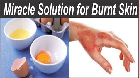 Burn Skin. First Treatment Human Hand Fire or Chemical Destruction