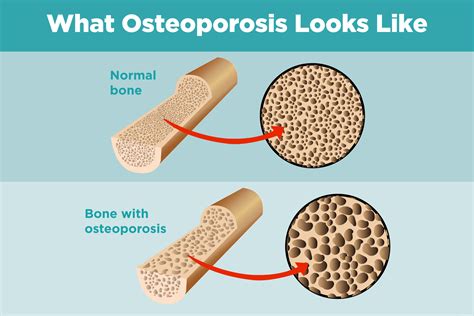 how does osteoporosis weaken bones check all that apply