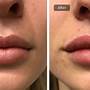 how long does it take for fillers to settle in lips
