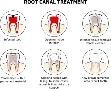 How Long Does It Take To Do A Root Canal Treatment