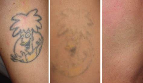 How Many Sessions Of Tattoo Removal For Cover Up Laser Do You