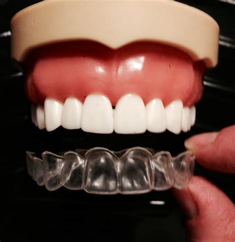 Teeth Whitening Dental Trays Custom Made by Professionals Using A DIY