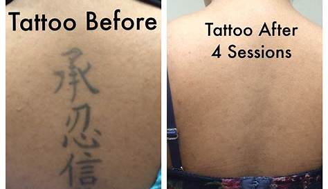 How Much Does Laser Tattoo Removal Cost Near Me Zerkalovulcan