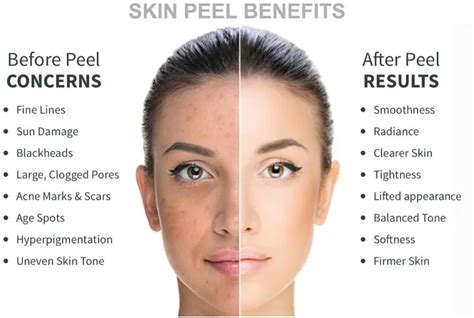 chemical peels for acne scars chemical peel for acne & scars before