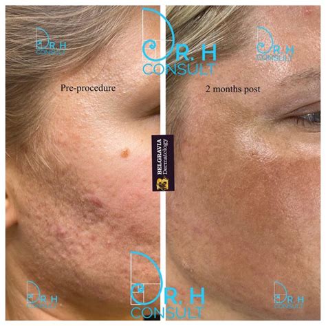 how much is laser treatment for acne scars