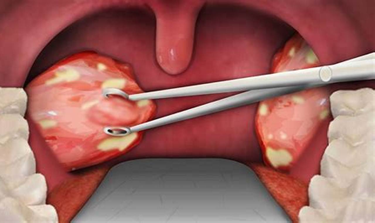 How Much Is Tonsil Removal With Insurance?
