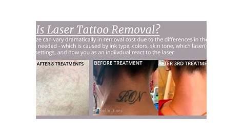 How Much Laser Tattoo Removal Cost Treatment Free Ideas