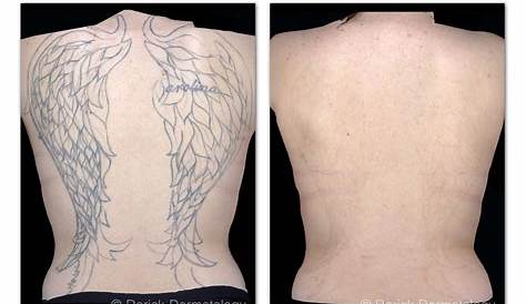 How Painful Is Picosure Tattoo Removal TATTOO REMOVAL PicoSure