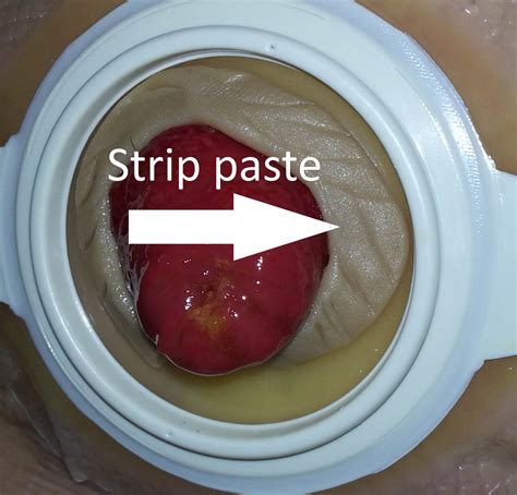 A Mini Guide to Stoma Paste Ostomy Care Tips VeganOstomy